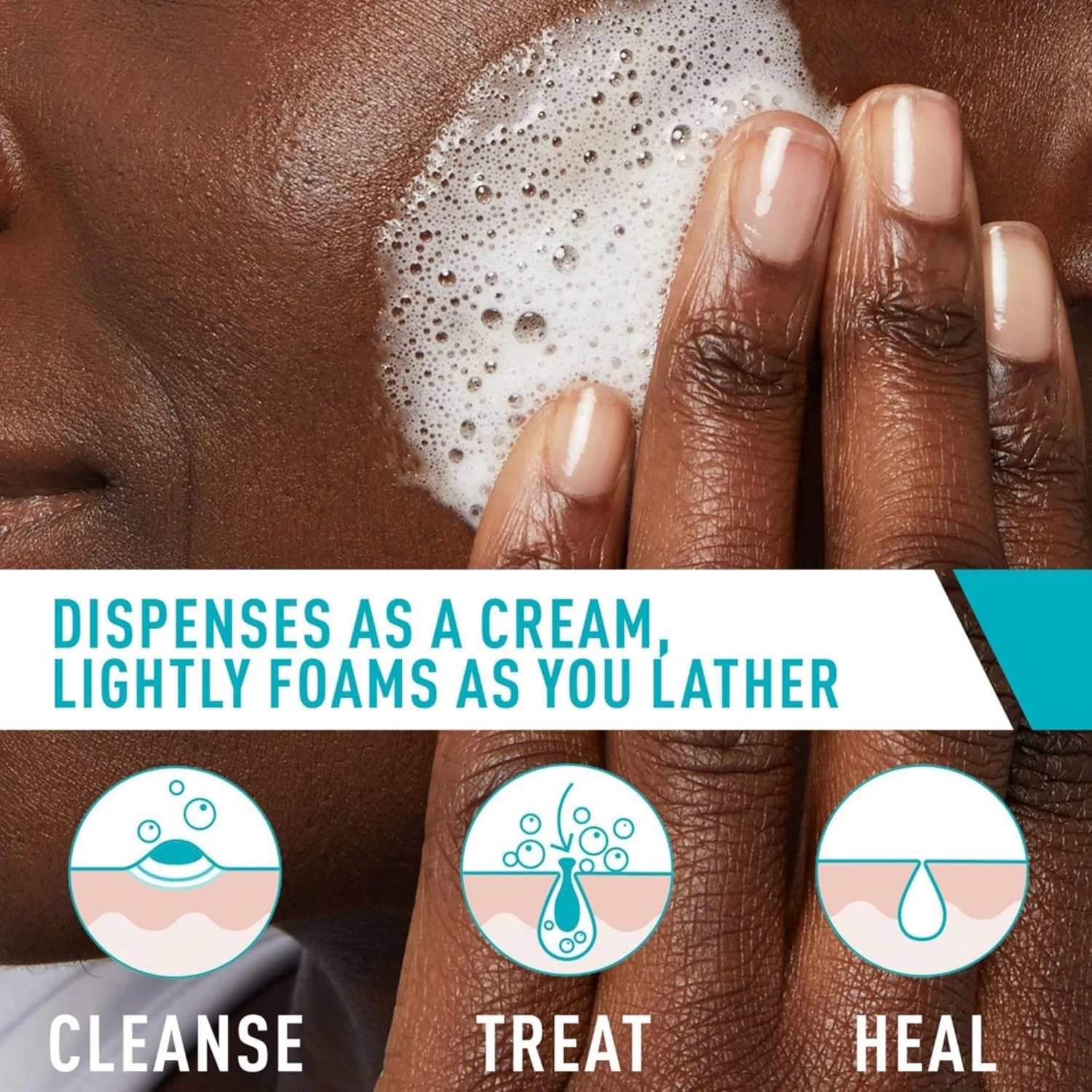 CeraVe Acne Foaming Cream Cleanser, 5 Fl Oz (Pack of 1), Packaging may Vary