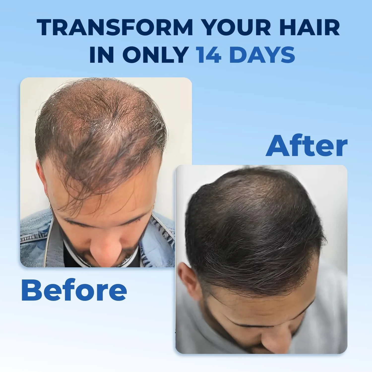 FEGPLUS Rosemary Beard & Hair Growth Serum (50ml), Rosemary Extract Serum Hair S